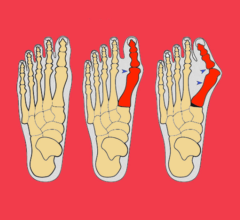Истринские врачи начали применять современное хирургическое лечение деформации стопы