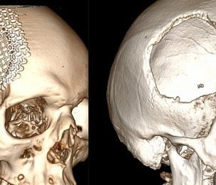 В Истре нейрохирурги восстановили обширный дефект черепа пациента с помощью 3D-импланта