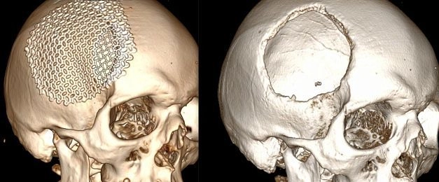 В Истре нейрохирурги восстановили обширный дефект черепа пациента с помощью 3D-импланта